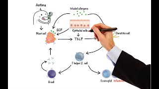 Azathioprine With Budesonide Induces Remission More Effectively Than With [upl. by Eniamat]