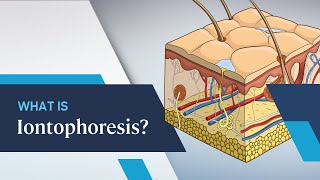 What is Iontophoresis [upl. by Arlo]