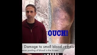 Hematoma leg bruising and swelling [upl. by Hgeilhsa]