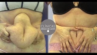 Abdominoplastia Antes y Después  Experiencia Mari Carmen [upl. by Sluiter]