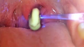 Tonsil Stones Explained In Under 3 Minutes [upl. by Nyssa]