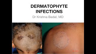 Dermatophyte infections of Skin [upl. by Bicknell90]