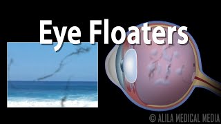 Eye Floaters and Flashes Animation [upl. by Koerner]