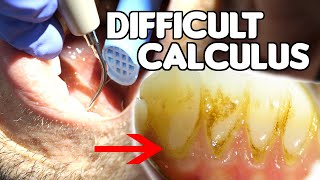 How To Remove Difficult amp Tenacious Calculus Tartar [upl. by Melar]