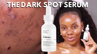 ALPHA ARBUTIN THE ORDINARY THE TRUTH ABOUT THE ORDINARY ALPHA ARBUTIN HOW TO GET RID OF DARK SPOT [upl. by Leummas]