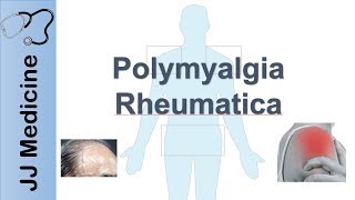 Polymyalgia Rheumatica  Signs amp Symptoms Diagnosis and Treatment [upl. by Machute]