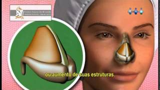 O QUE É RINOPLASTIA Video Como é feita Dói Quais as indicações e riscos [upl. by Angi120]