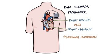 Understanding Pacemakers [upl. by Ellicott385]