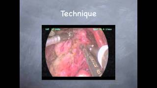 Minimally Invasive Endoscopic Thyroidectomy [upl. by Ylrak]