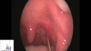 Tonsil Stone Removal  Tonsillolith removal by Dr Raman Dhungel [upl. by Enairda]