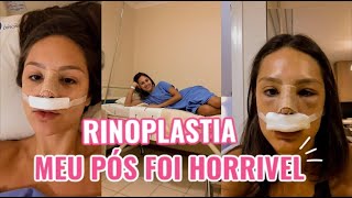 Minha Rinoplastia  como foi o pós COM FOTOS [upl. by Ahseik815]