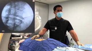 Radiofrequency Ablation Procedure [upl. by Ynettirb]