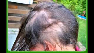 Antiscal  Alopecia Areata [upl. by Notle]