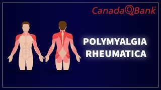 Polymyalgia Rheumatica [upl. by Pucida]