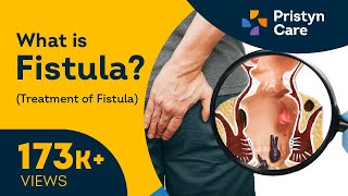 What is Fistula  Symptoms amp Treatment of Fistula [upl. by Oppen]