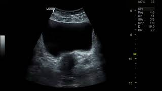 Bicornuate uterus pregnancy [upl. by Kaye]