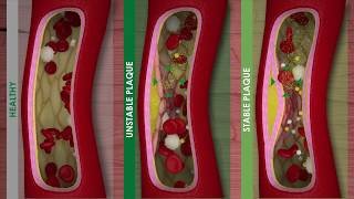 ATHEROSCLEROSIS and CARDIOVASCULAR DISEASE [upl. by Herriott]