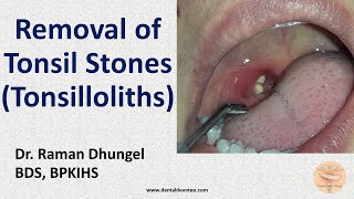 Endoscopy  White spot on tonsil  Chronic tonsillitis [upl. by Denman]