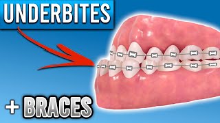 How Do Braces Fix Underbites  Premier Orthodontics [upl. by Sophronia]