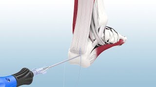 Haglunds Excision and Achilles Reconstruction Using the CuffLink™ System  CONMED Animation [upl. by Cartwright]