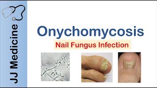 Onychomycosis  Nail Infection  Signs Symptoms Treatment [upl. by Augustine]