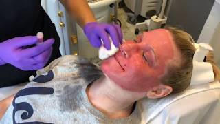 TRL Laser For A Dramatic Skin Rejuvenation [upl. by Juli]