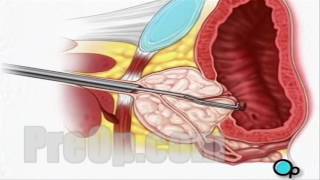 TURP Transurethral Resection Prostate Surgery patient education series [upl. by Edvard]