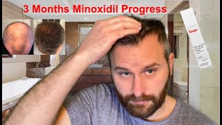 3 Months Results With Minoxidil Generic Rogaine  What You Can Expect [upl. by Neeka]