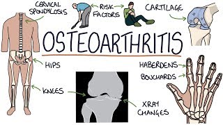 Understanding Osteoarthritis [upl. by Cynthy]