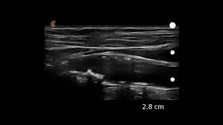 Image Interpretation Carotid Atherosclerosis [upl. by Aed]