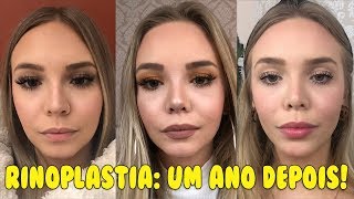 RINOPLASTIA RESULTADO FINAL APÓS UM ANO ANTES x DEPOIS [upl. by Corena]