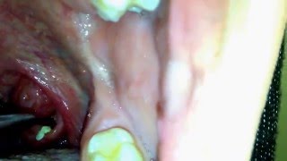 Tonsil Stones Removal Causes and Treatment [upl. by Aidualk]