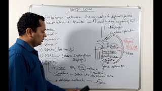 Understanding Stomach and Duodenal Ulcers [upl. by Helsie251]