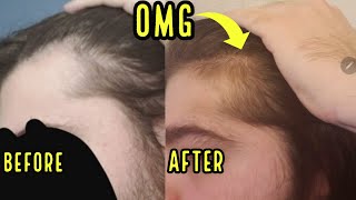 INSANE HAIR GROWTH FROM ORAL MINOXIDIL INCREDIBLE RESULTS [upl. by Anide97]