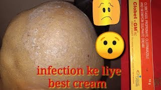 Clobet।GM।Clobetasol Propionate।Clotrimazole And Neomycin Sulphate Cream Review।Sonu Kumar Mishra। [upl. by Kcirde782]