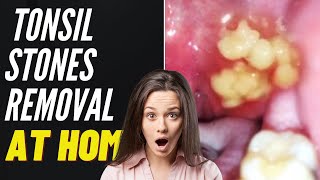 Tonsil Stones Removal At Home [upl. by Roger]