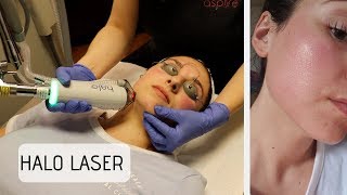 HALO LASER TREATMENT  Honest Review [upl. by Ydnir943]