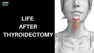 Life after Thyroidectomy [upl. by Sofie]