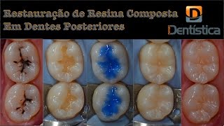 Restauração de resina composta em dente posterior [upl. by Teador]