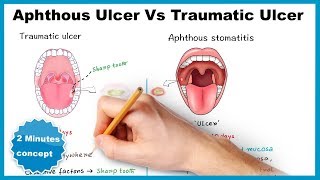 Aphthous ulcerstomatitis Vs Traumatic ulcer [upl. by Haras360]