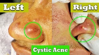 Drainage de lacné kystique sur le nez  cystic acne extraction [upl. by Corotto]