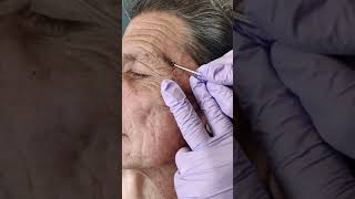 Acne extraction of blackheads and whiteheads popping pimples in Los Angeles [upl. by Nylsaj]