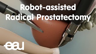 Robotassisted Radical Prostatectomy RARP [upl. by O'Driscoll]