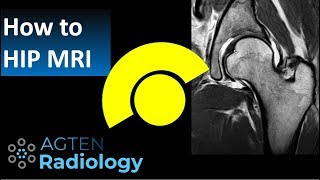 How to Read Hip MRI [upl. by Averell]