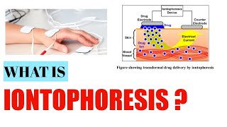 Iontophoresis Electrotherapy [upl. by Linad]