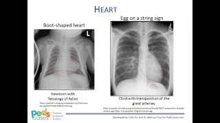 Approach to Pediatric Chest XRays [upl. by Fisk664]