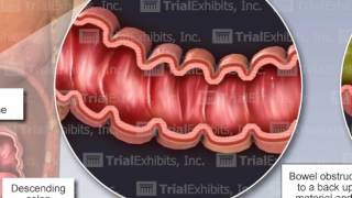 Bowel Perforation [upl. by Ruthanne]