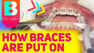 Getting Braces 101  Putting Braces On [upl. by Rosaleen]