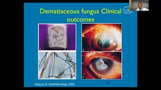 Lecture Fungal Keratitis [upl. by Lenuahs]