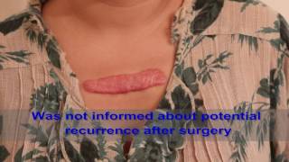 Chest Keloids  Mistakes to Avoid [upl. by Ettenav]